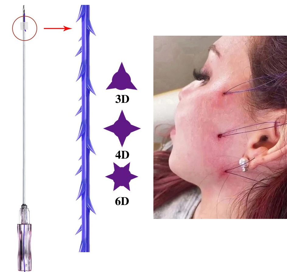 Medical Korea Face Lift Pdo Thread Barb Nose Lifting 3d 4d Barb Cog Thread