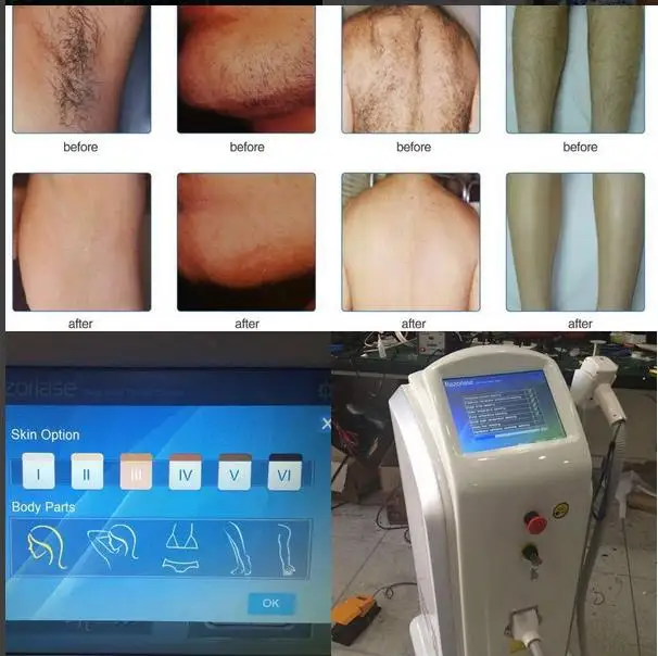 2022 Newest 1600w/1800w/2000w high power  diode laser machine triple wavelength hair removal diode laser machine