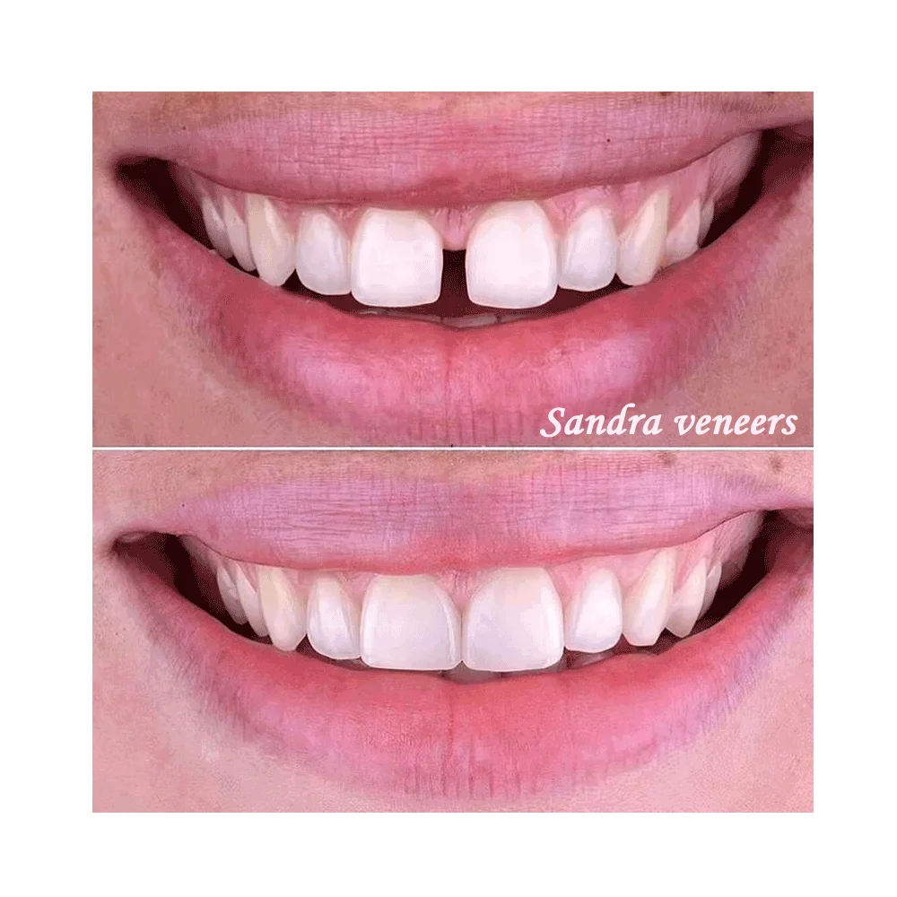 Hot Selling Cosmetic Kit Pro False Dental Denture Hp95 Top And Bottom Set Using Bonding Technology resin Tooth Veneer