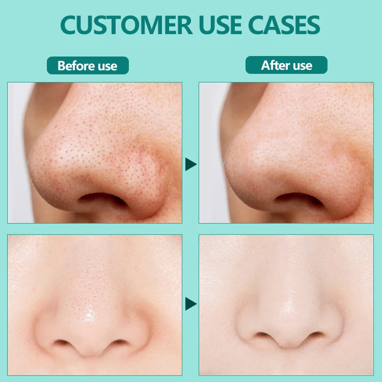 Private Label  Organic Bamboo Charcoal Deep Cleansing Blackhead Removal Peel Off Patches Pore Sharking Black Nose Strips