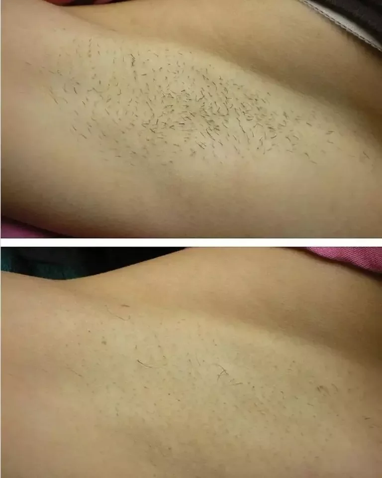 USA Sincoheren 1200W Diode Laser Hair Removal Machine 808nm 755nm 1064nm unichill painless for Fitzpatrick skin types I-VI