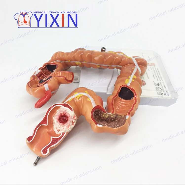
YIXIN/Model of human colon disease Model of large intestine Pathological,Disease Large Intestines 
