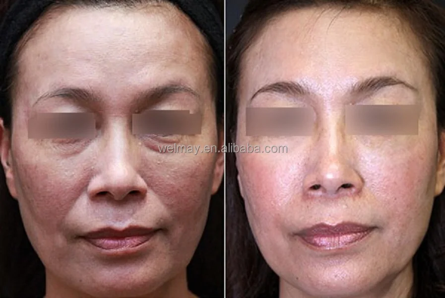 7 Tips 1MHZ RF Radio Frequency Machine Monopolar RF Face Skin Tightening Radio Frequency Ablation Beauty Device