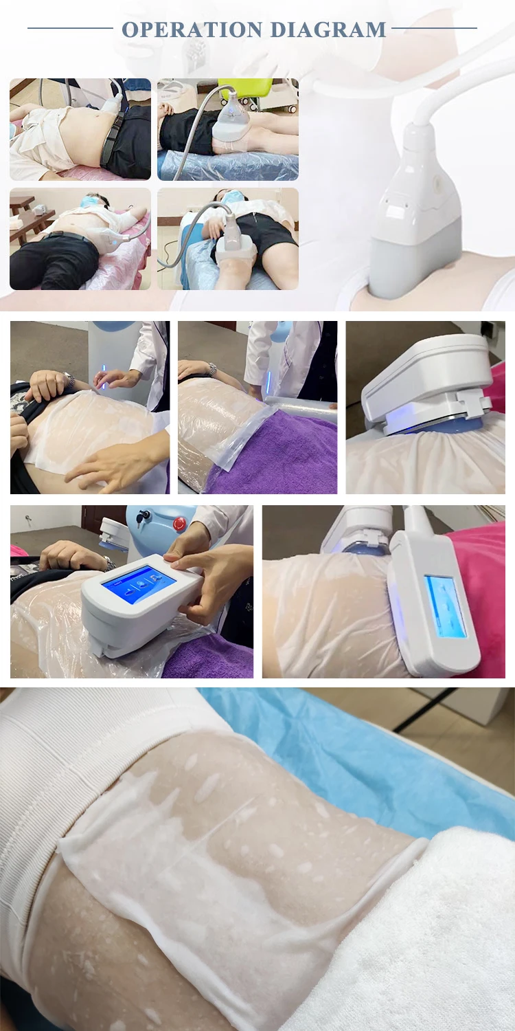 High Quality Non-woven Antifreeze Membrane For  Slimming Machine