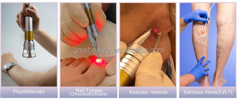 New invention product 980nm 905nm laser toenail nail fungus treatment machine