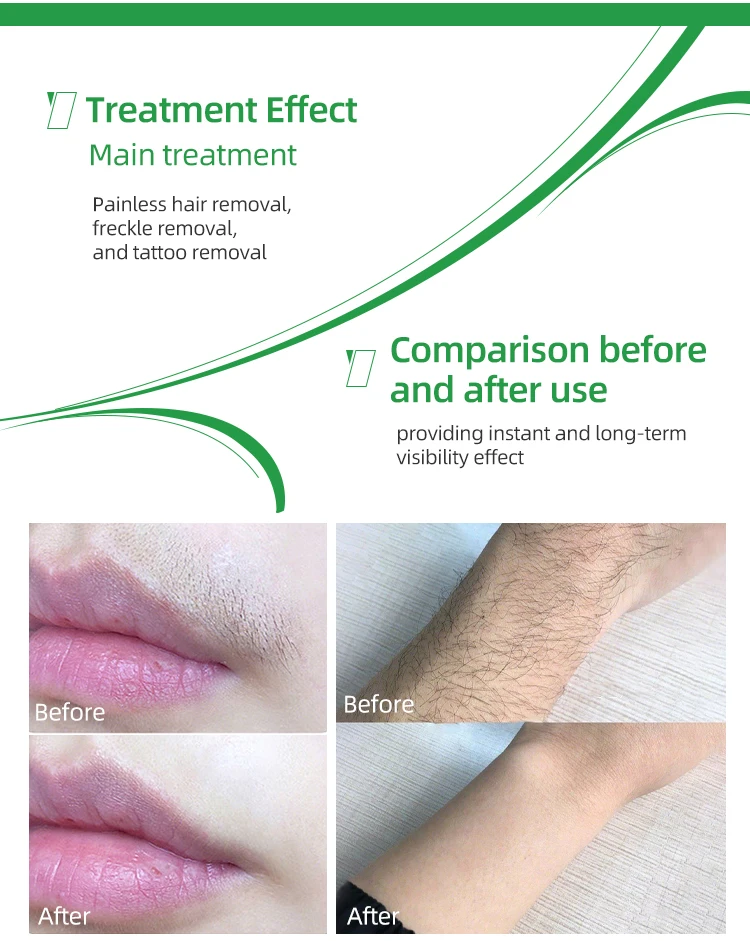 Bowket fast painless permanent hair remove diode laser for 808nm