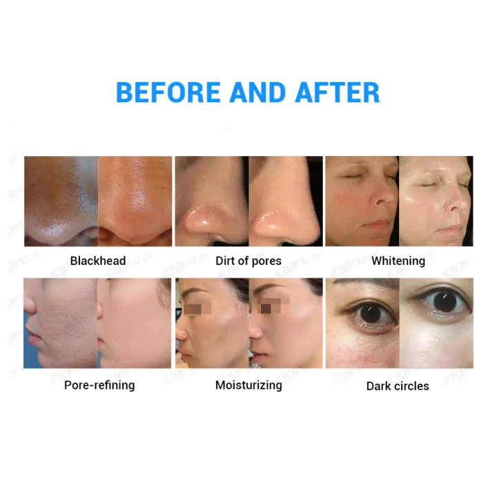 Алмазная дермабразия для лица oxygeneo, машина для ухода за кожей