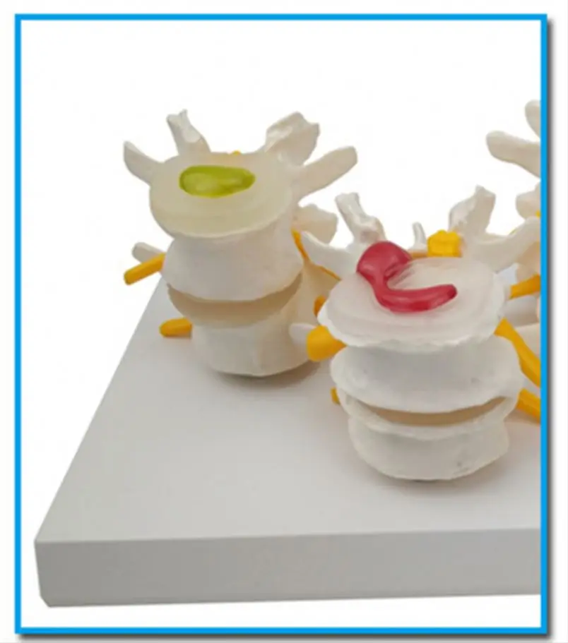 
The diseased model of vertebrae 