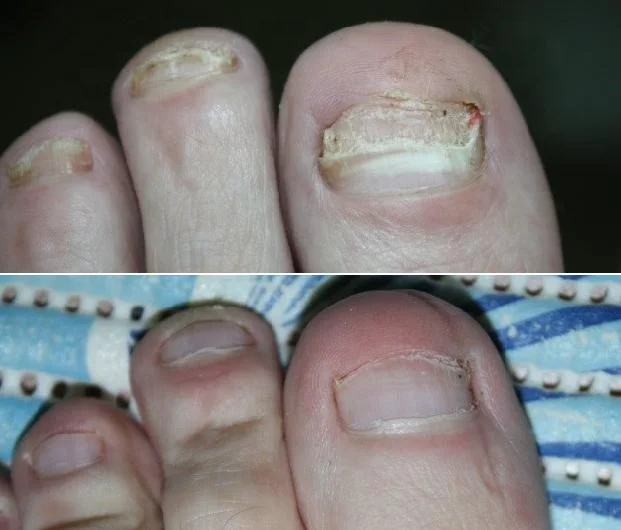 2024 Hot Sale 980nm Diode Laser Podiatry Physical Therapy Equipment Pain Relief Diode Laser Treatment for Onychomycosis