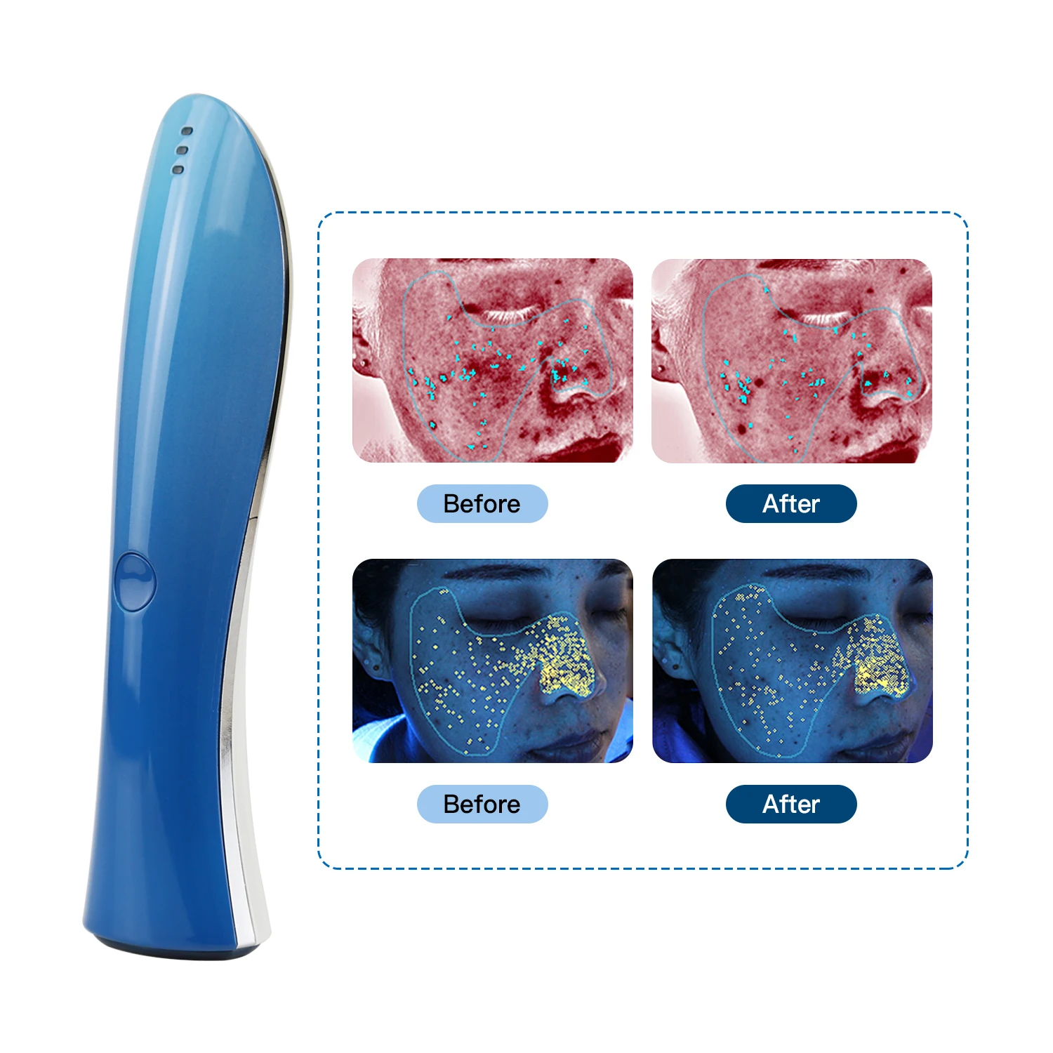 Newest Skin Rejuvenationn Plasma Beauty Device Acne Anti-inflammatory Professional Facial Plasma Beauty Device for Personal Care