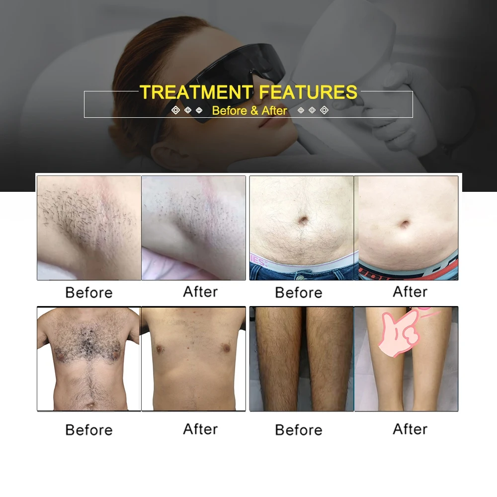 2023 New Design TEC Ice Cold Hair Removal Machine 755nm 808nm 1064nm Laser Hair Removal