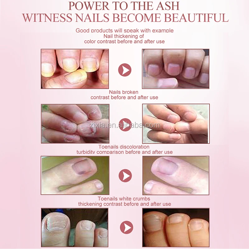 
2020 Wholesale herbal nail repair essence nail treatment for ingrown toa nail anti onychomycosis 