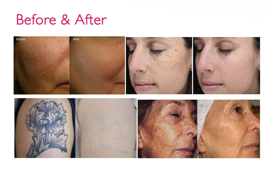 wholesale ipl q switch nd yag laser machine 1064nm pigmentation corrector