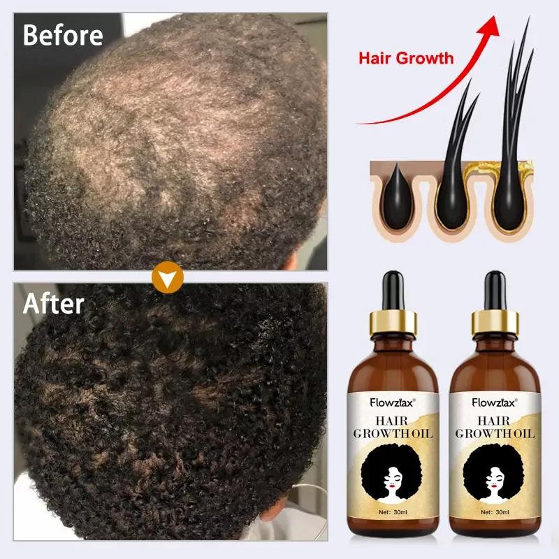 Natural Organic Private Label Vegan Treatment for Baldness Hair Growth Essential Oil Herbal Anti-Hair Loss Hair Growth Oil