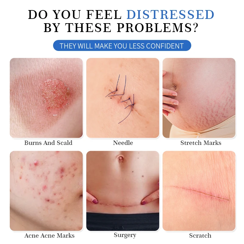 Hot selling effective scar remover old scar on face legs skin repair removal scar cream