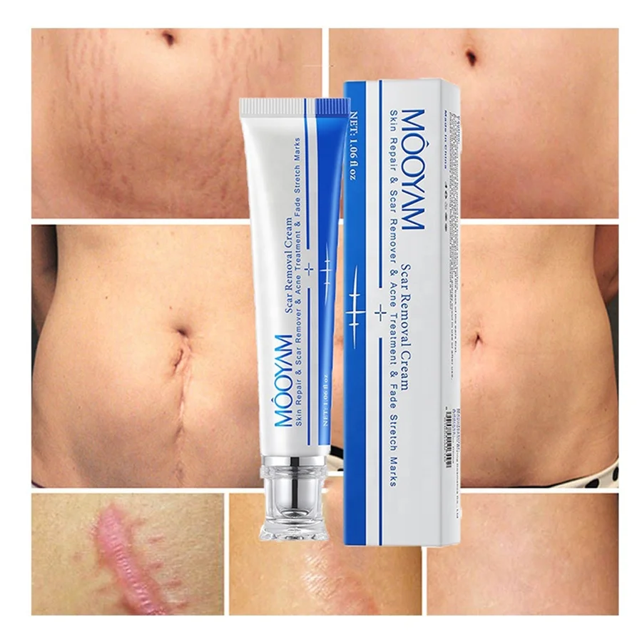 Fastest Acne Scar Removal Cream Scar Gel Bruises Repair Cream Tummy Tuck Tightening Stretch Mark Scar Removal Cream