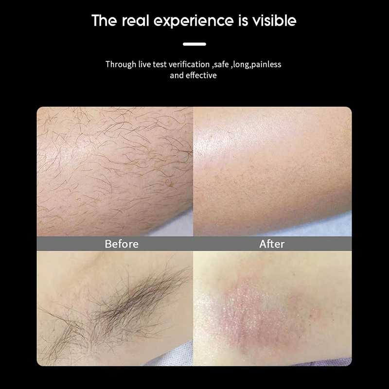 Dpl Opt ipl laser hair removal machine price ipl Skin Rejuvenation Acne Treatment Vscular Removal IPL Machine