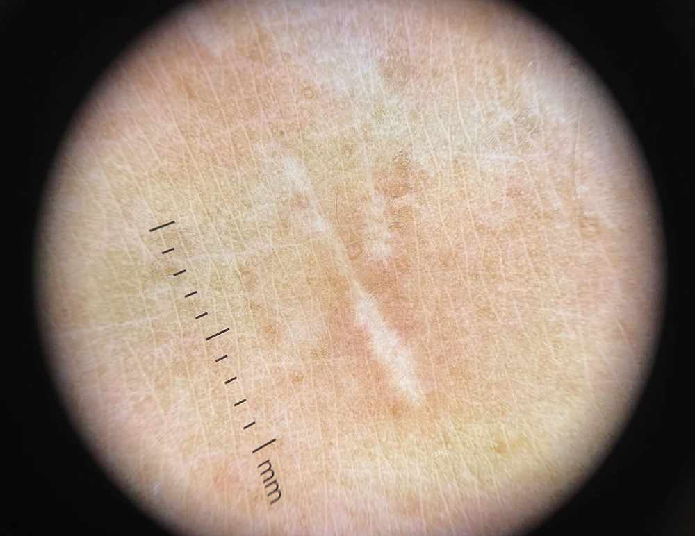 Factory Wholesale 10X Magnify Dermatoscope with Removable Contact Plate