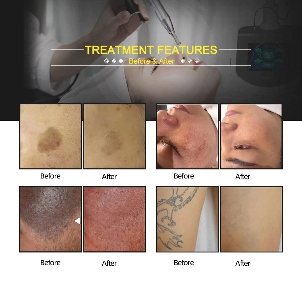 tattoo removal laser portable pigment removal laser medical aesthetic medicine professional laser beauty pigment removal