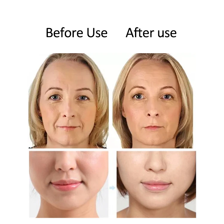 Other Beauty & Personal Care Products(new) Nasolabial Folds Laugh Lines Nasolabial Folds Patch, Lines Laugh Wrinkle Patches