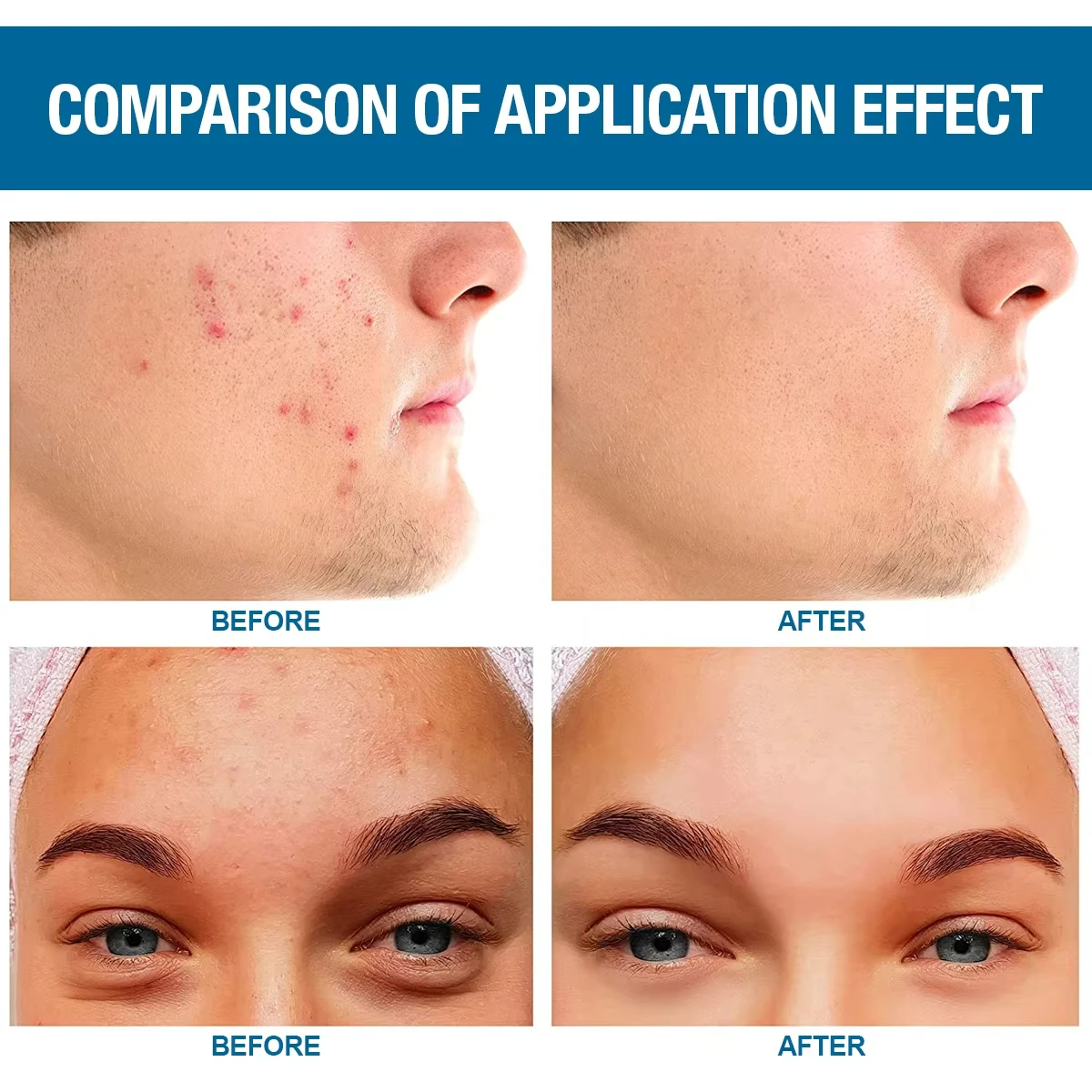 Hydro Seal Acne Patches for Face Non-Medicated Acne Blemish Patch Absorbs Fluids Provides a Protective Healing Environment