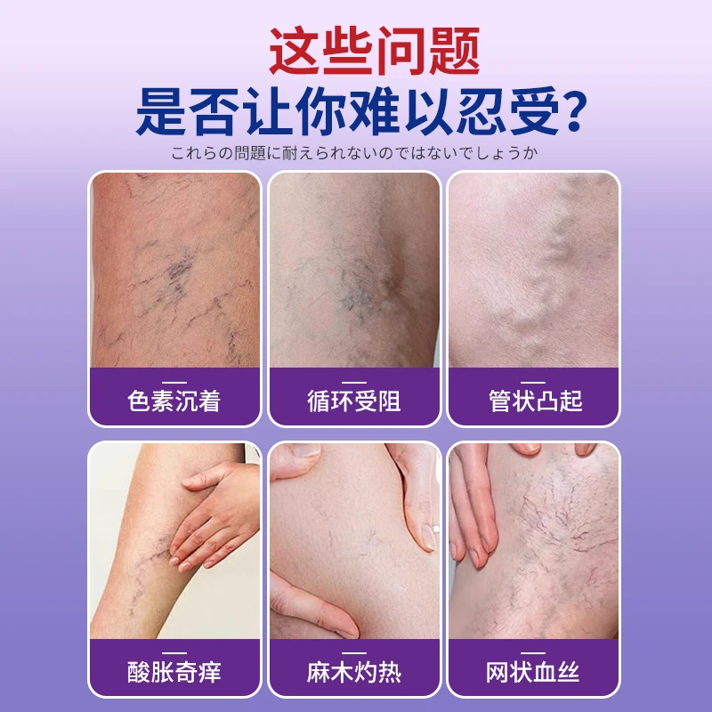 Iwai Minhong Chinese Plaster Ointment for Varicose Veins Effectively Relieves Earthworm Vascular Veins Protrusion