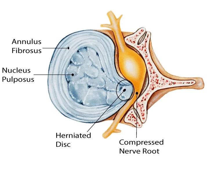 New diode surgical  pldd laser surgery equipment for numbnesssciatica laseev diode laser 980nm+1470nm
