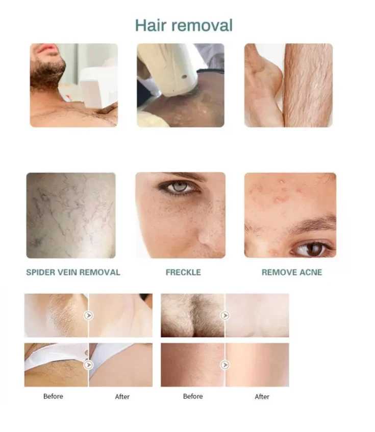 Hot Sale Dpl Laser Machine Skin Rejuvenation Acne Pigmentation Treatment Machine Dpl elight ipl