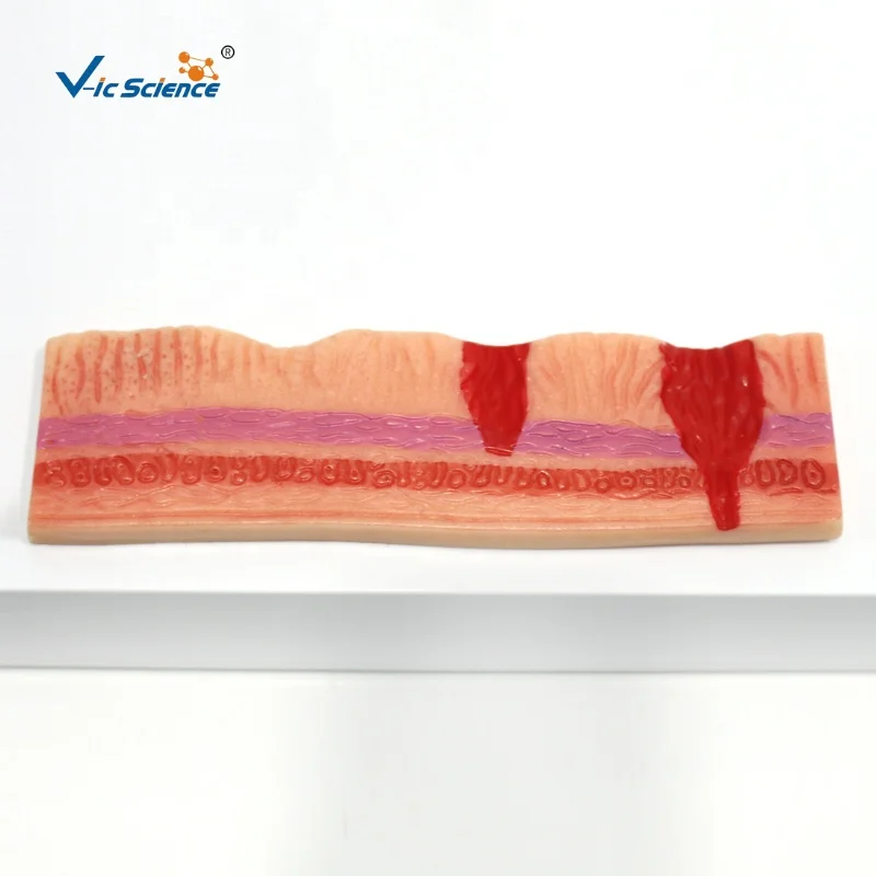 medical anatomical model Hot quality BN Plastic Stomach diseased  Gastric ulcer  anatomy model medical science education model