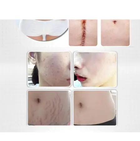 
Essential Massage oils Scar Removal Lavender Oil For Pregnant Women Hyaluronic Acid Serum Oil Essential Face Anti Acne 