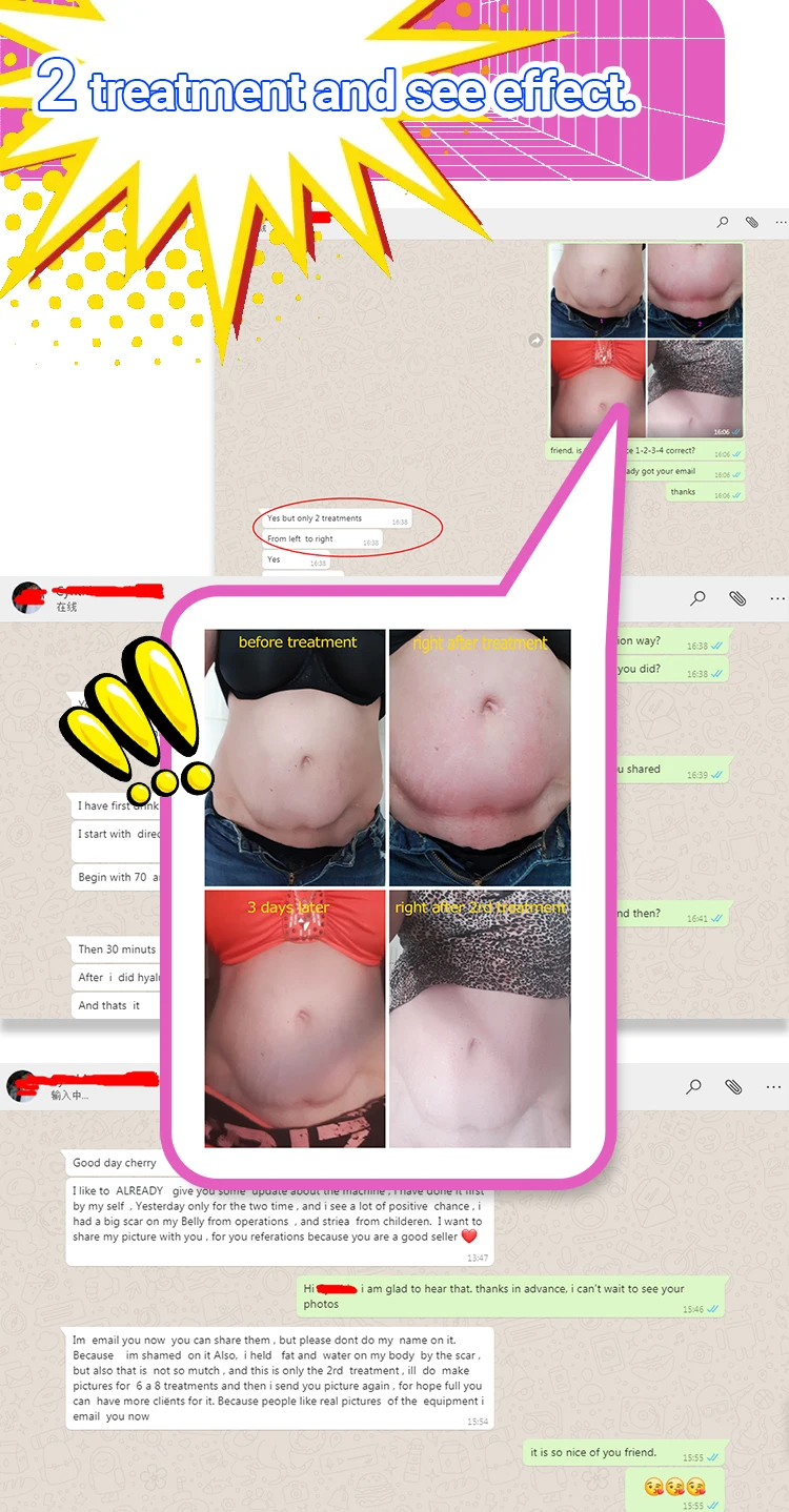 SUSLASER cavitation RF SMOOSKIN I S60 CE/ISO ultra cavitation professional machine cavitation y radiofrecuent