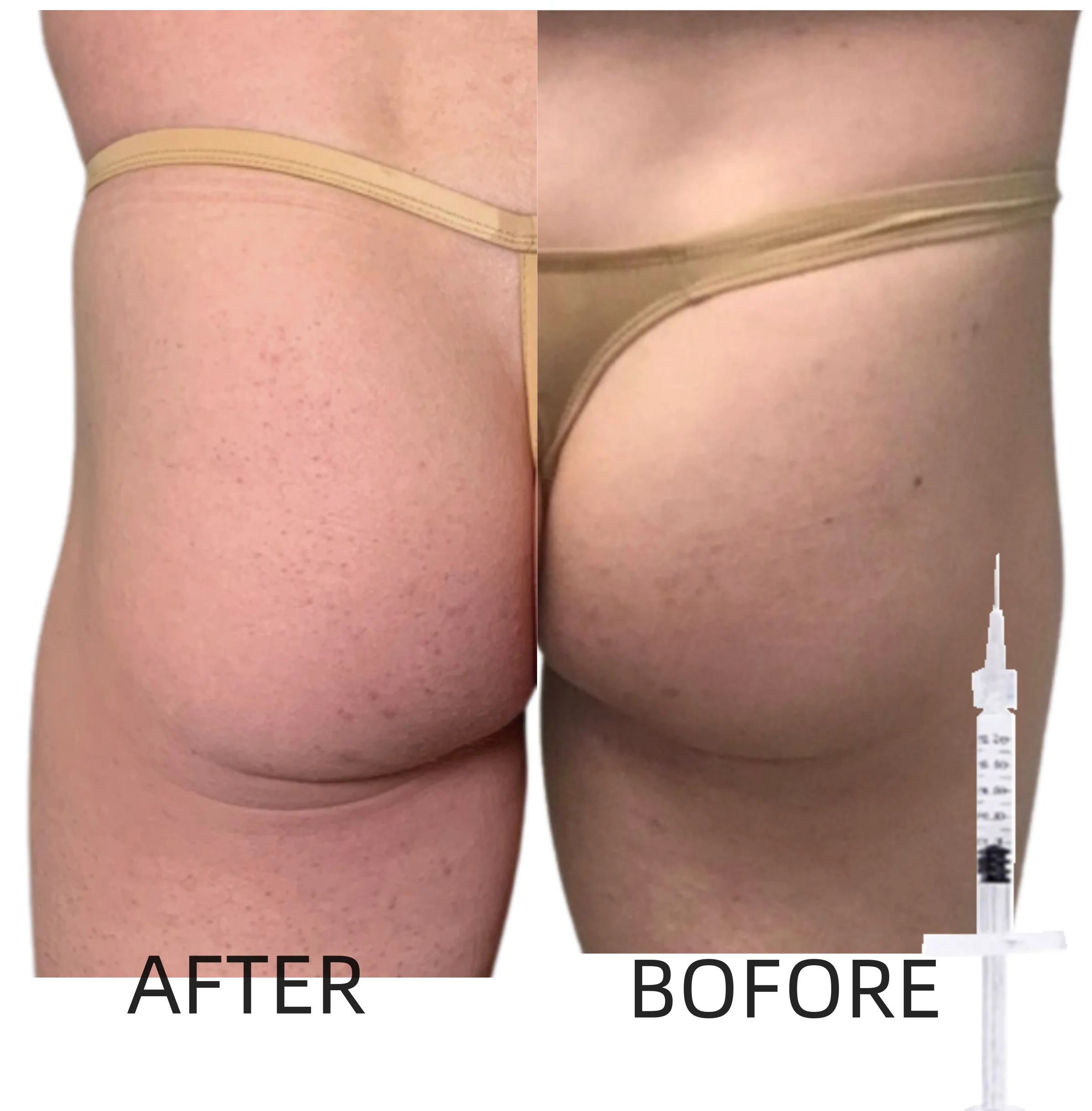 REJEON Subskin 50ml Dermal Filler Big Buttock Breast Enlargement Hyaluronic Acid Gel Injection For Hip butt filler