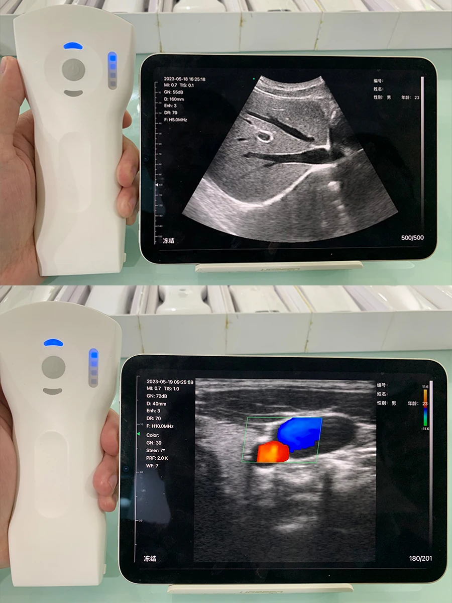 Wireless Medical Ultrasound Probe Portable And Convenient For Diagnostic Imaging