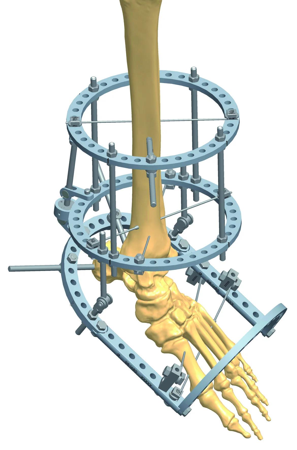 
Hot Sale Black Stainless Steel Elbow Joint External Fixator 