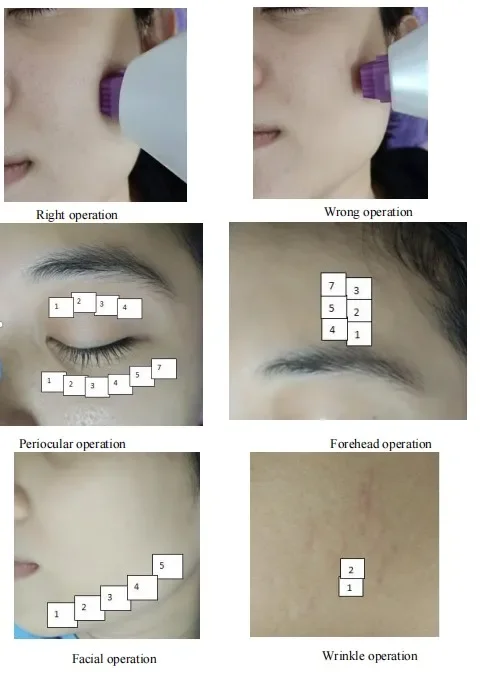 Beauty products cold plasma personal beauty device in the world cold plasma machine disinfects the skin