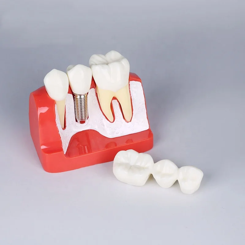 Dental Teeth Caries Model Removable, Model Teeth for Dental Education Supplies, Tooth Pathology Display