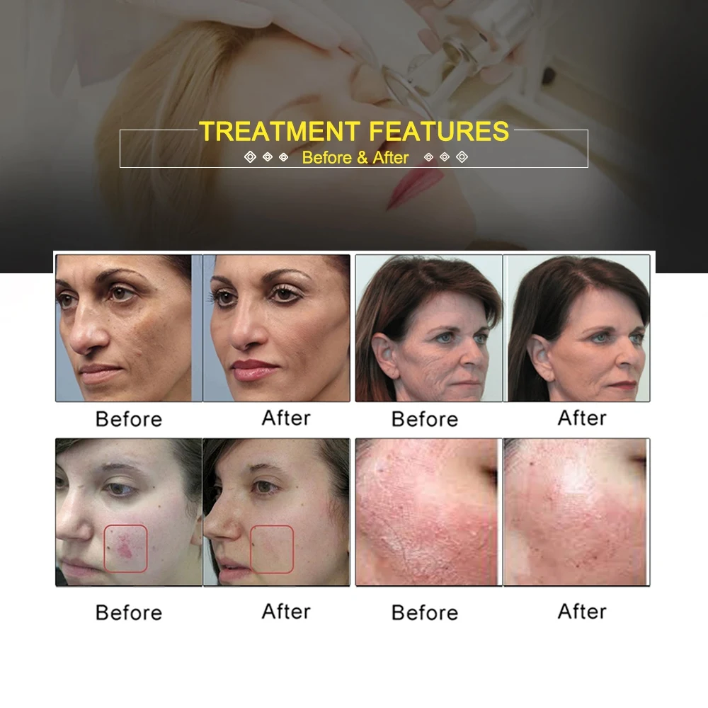 Fractional Laser Vagina Tightening Acne Scar Treatment Co2 Fractional Laser Beauty Device Vaginal Rejuvenation Laser Machine