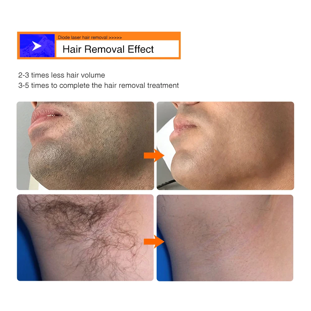 2023 Newest Professional Cloud computing Ice Cooling Titanium 1200W 755 808 1064 diode laser hair removal machine