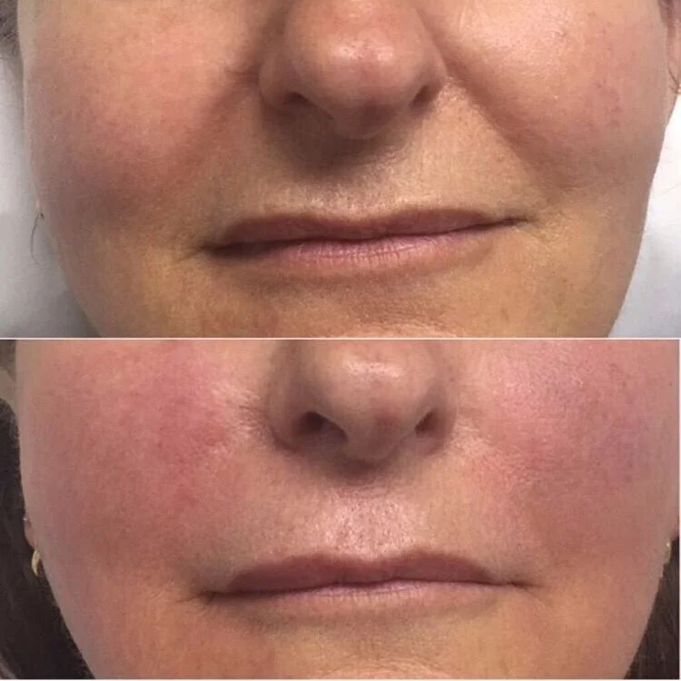 
CE ISO Approved 1ml Hyaluronic Acid Injectable Filler Women Men for Anti Wrinkle Nasolabial Folds with 0.3% Lido 