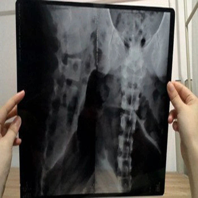 China Kenid Medical dry X-ray films 10*12inch thermal blue dry X-ray digital printable films