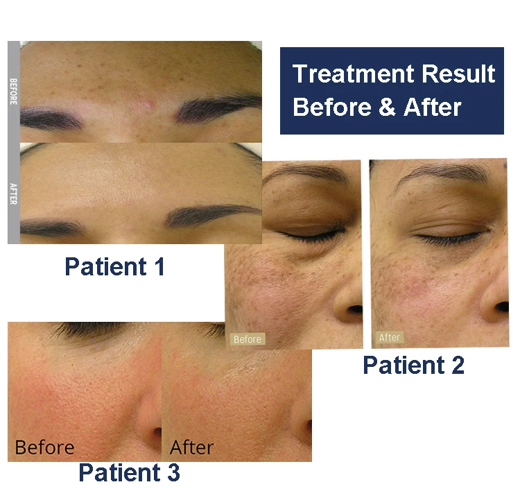 RF skin tightening water Dermabrtasion Oxygen Aqua Peel Jet whitening oxy facial machine american machine