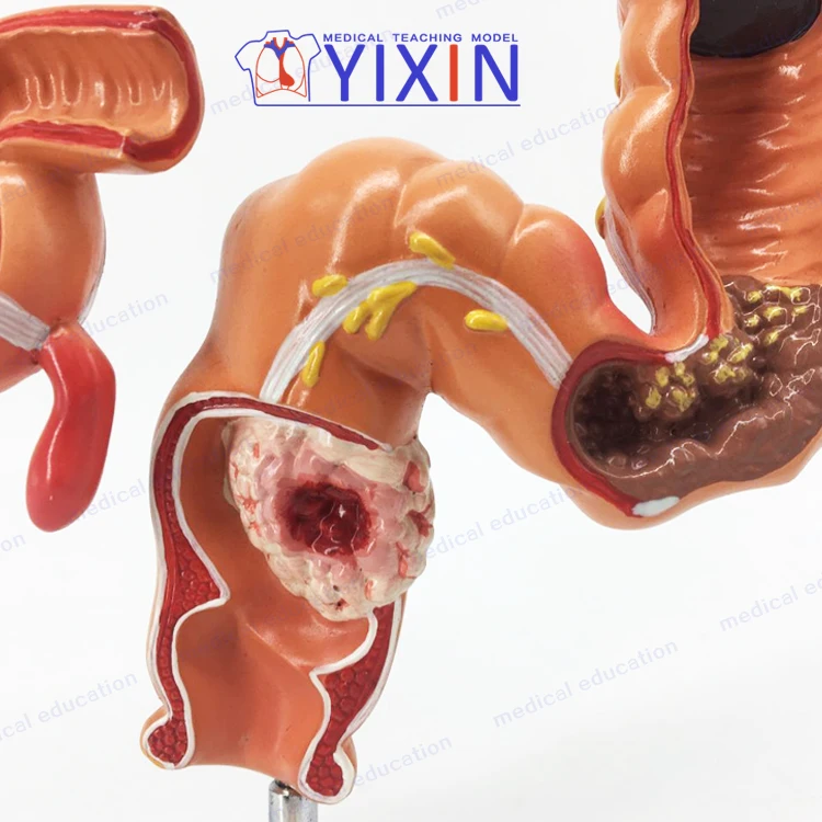 
YIXIN/Model of human colon disease Model of large intestine Pathological,Disease Large Intestines 