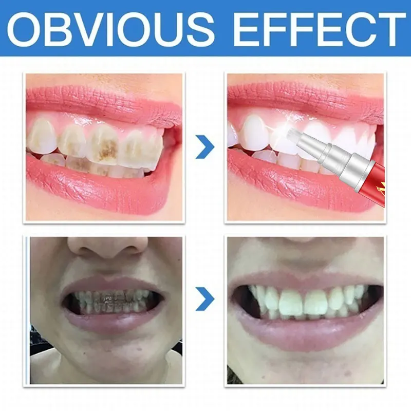 Teeth Whitening Tooth Brush Machine Oral Hygiene Cleaning Serum Removes Plaque Stains