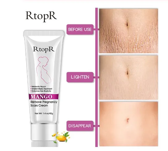 Mango Remove Pregnancy Scars Acne Cream Stretch Marks Treatment Maternity Repair Anti-Aging Anti Winkles Firming Body Cream