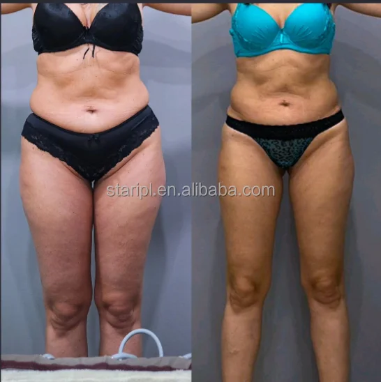 Non surgical no pain weight loss 6D Lazer Lipo Machine Liposuction Laser remove fat without cut clinically proved