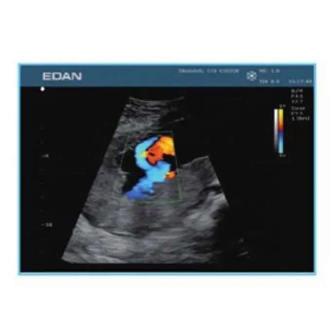 NEW Edan U50 Color Doppler Portable Ultrasound Machine Edan Ultrasound Machine