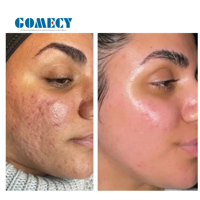 RF micronee fractional beauty machine golden micro needle 3 in 1 skin tightening morpheus 8