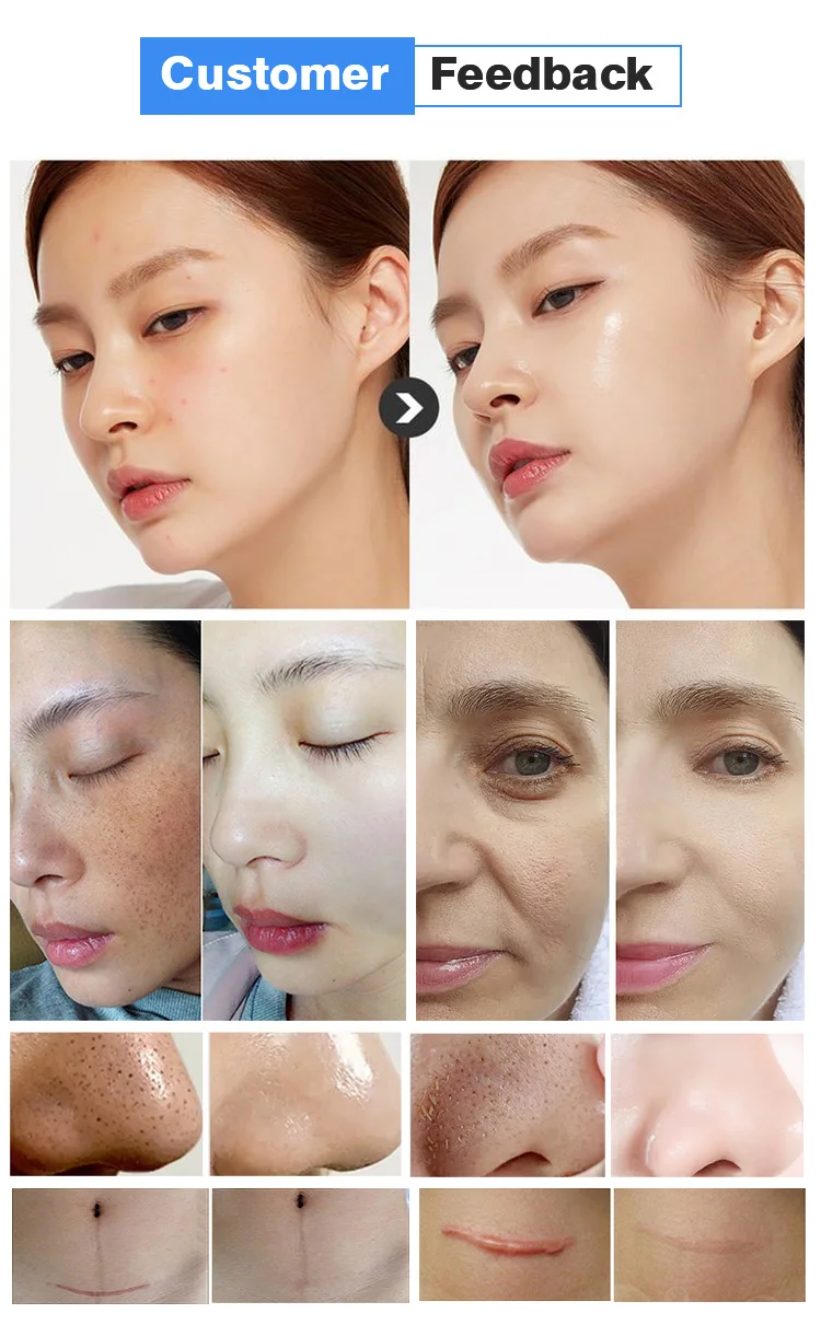 Hydra Dermabrasion Skin Clean Biopolar Rf Tightening Dermabrasion  microdermabrasion Diamond Hydra Facial Machine