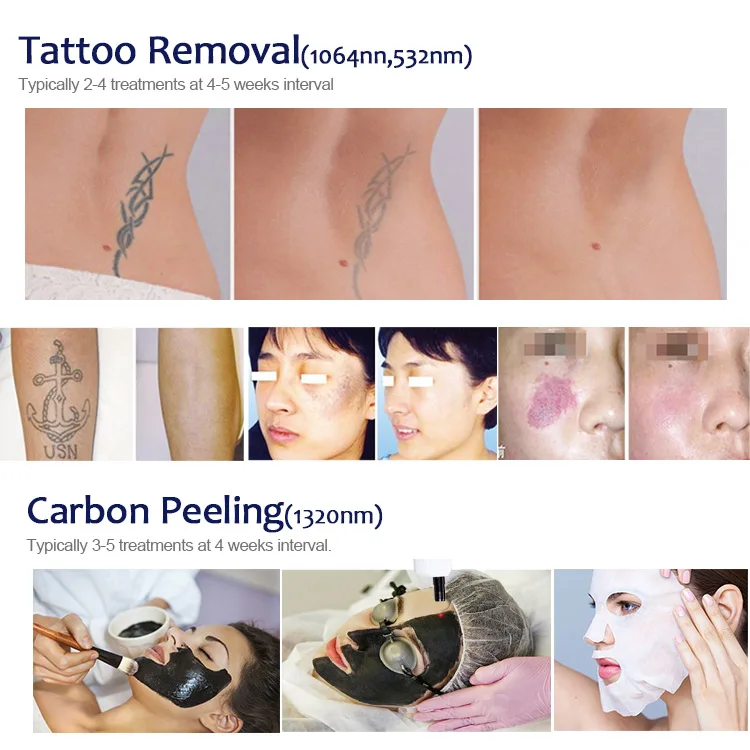KES switch ndyag laser system/tatto removal/skin rejuvenating system