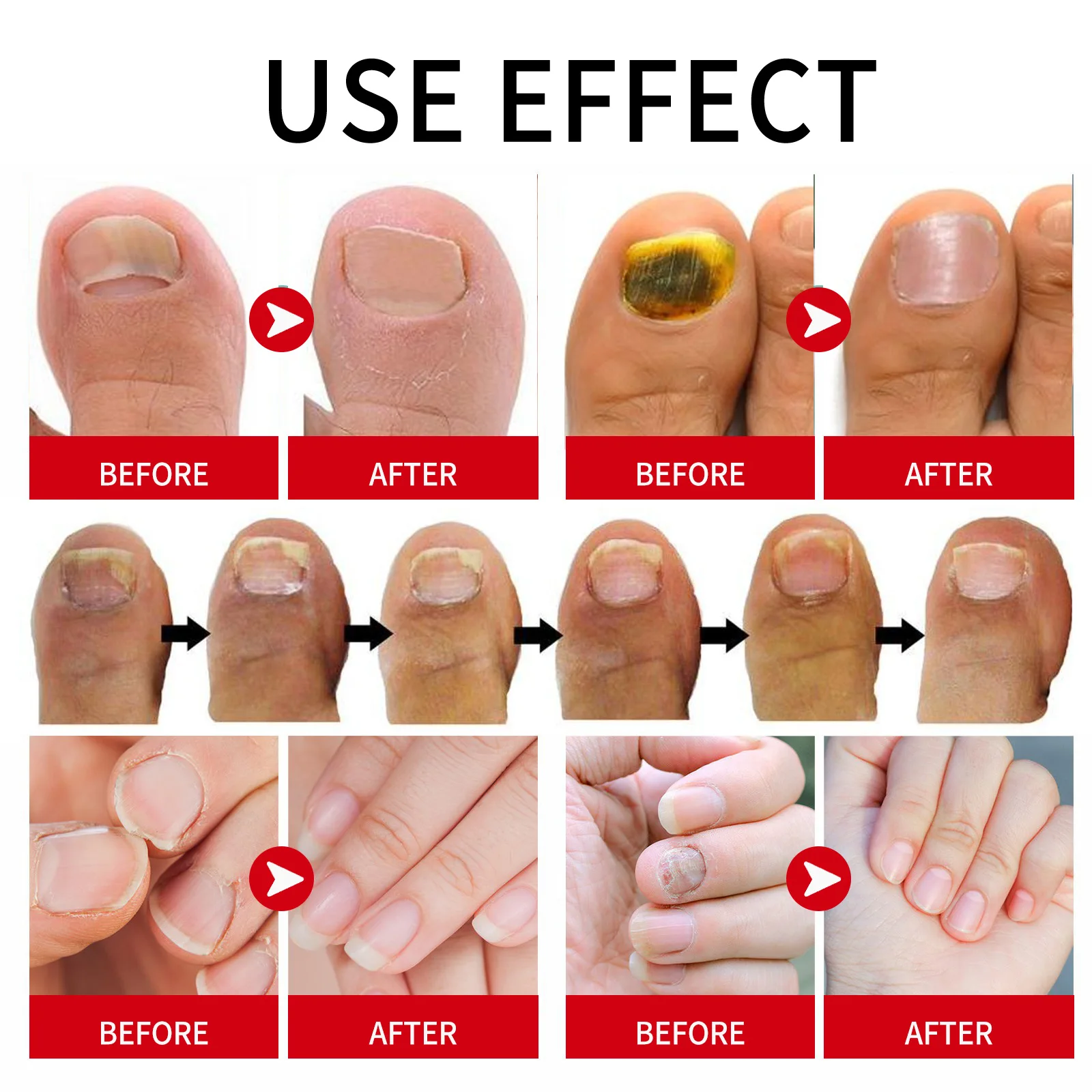 Feet Care Nail Foot Whitening Toe Nail Fungus Removal serum Gel Anti Infection Paronychia Onychomycosis Fungal Nail Treatment